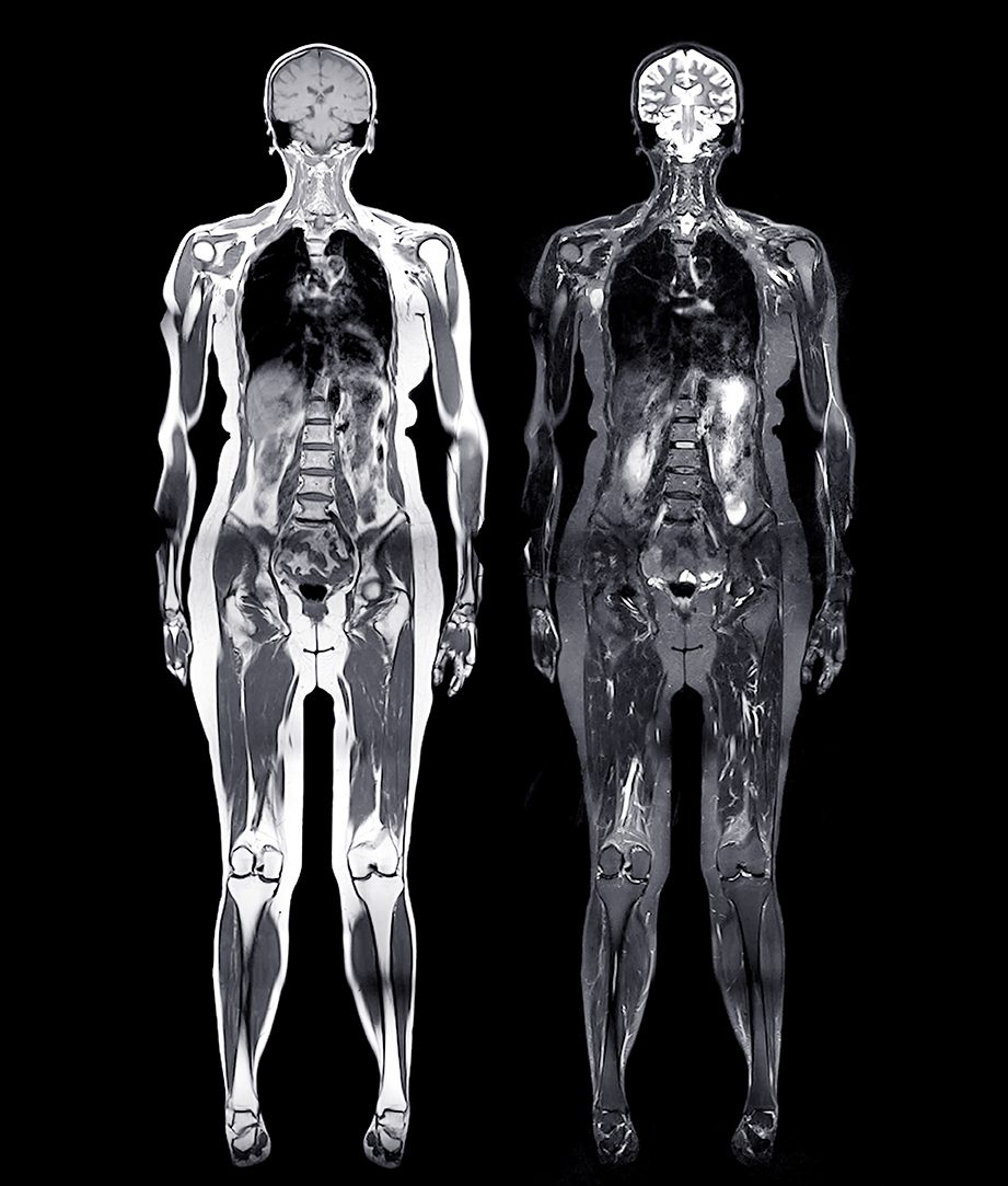 Mri,Whole,Body,Scans,Are,Beneficial,For,Early,Cancer,Detection, Beautiful old lady is doing exercise with dumbbell with the help of physiotherapist